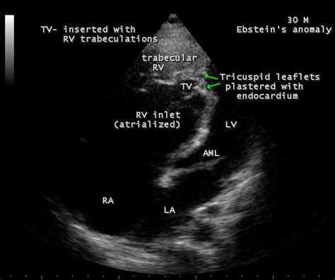 Tilted Apical View Showing The Insertion Of Tricuspid Leaflets Arrows