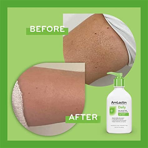 14 Best At Home Keratosis Pilaris Treatments 2023 How To Get Rid Of