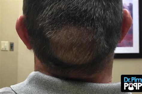 12 Types Of Bump On The Back Of The Head