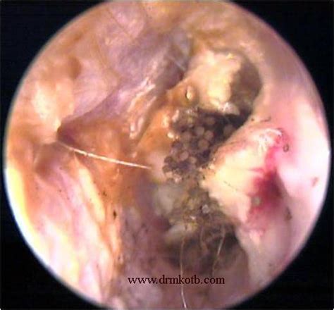 Candida Albicans Ear Treatment Yeast Infection And Candida Albicans