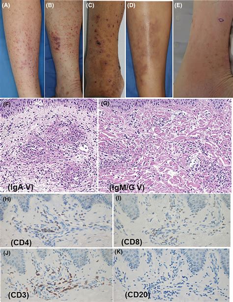 Clinical And Pathological Differences Between Skin‐limited Igmigg