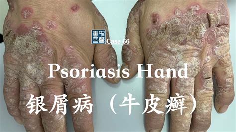 Hyperkeratotic Psoriasis Plaque 过度角化银屑病 Youtube