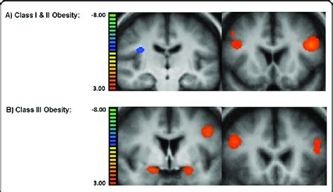 Neural Activations From The High Calorie Food Vs Non Food Visual Cue