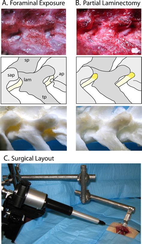Paravertebral Surgical Exposure For Ganglionic Injection Showing The Download Scientific