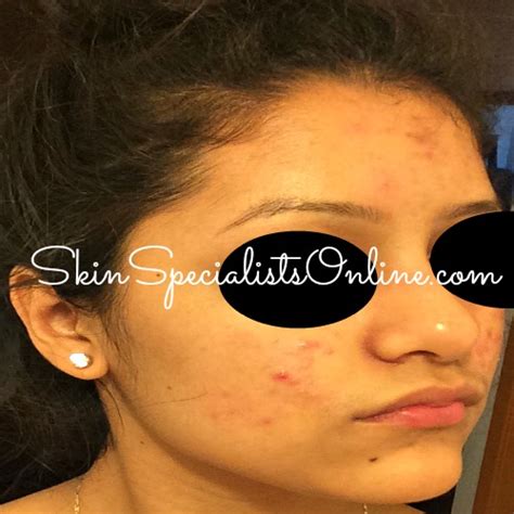 Inflammatory Acne Skin Specialists Online