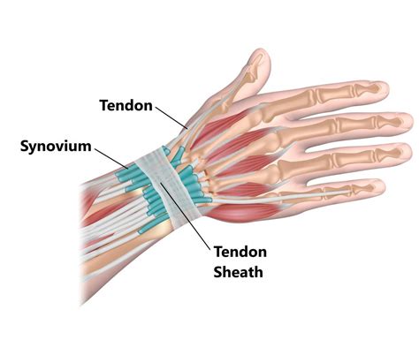 De Quervains Tenosynovitis Physiotherapy Total Physiocare Images