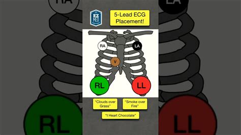 How To Place A 5 Lead Ecg Memory Trick Shorts Youtube