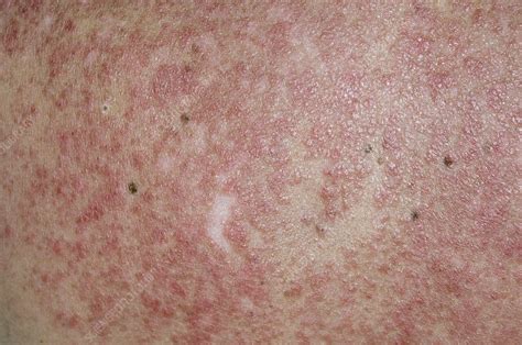 Lupus Rash On Back Triggered By Sun Stock Image C0069164 Science