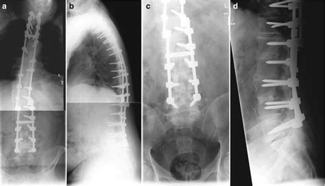 Releases And Osteotomies Used For The Correction Of Adult Lumbar