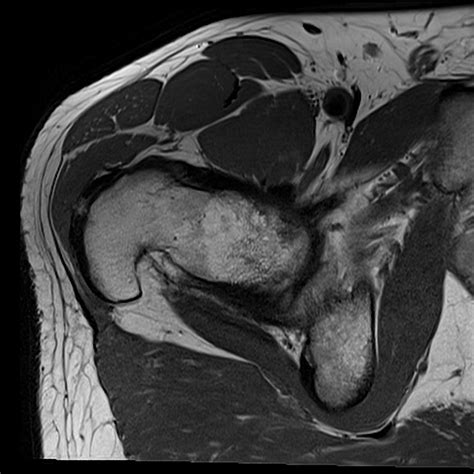 Normal Hip MRI Axial View Diagram Quizlet