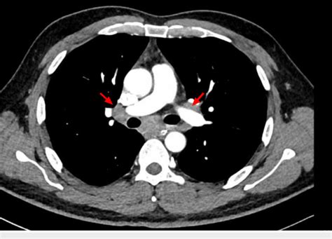 Computed Tomography Ct Scan Of The Thorax Red Arrows Paratracheal