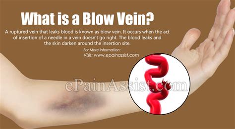 What Causes A Blown Vein And How Is It Treated