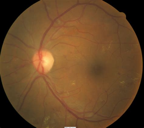 Clinically Significant Macular Edema Oct