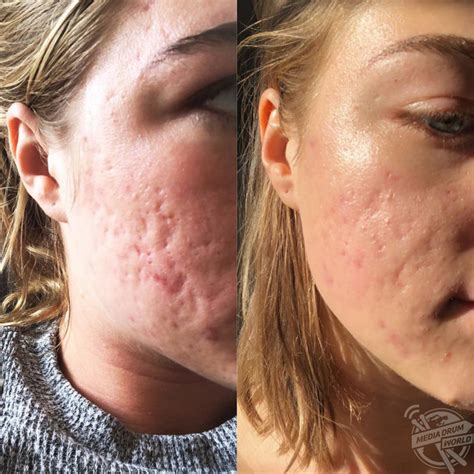 Cystic Acne Sufferer Talks Accepting Her Skin And Finding Love Despite