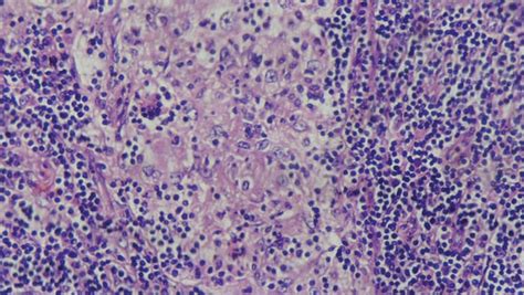 Scielo Brasil Sinus Histiocytosis With Massive Lymphadenopathy