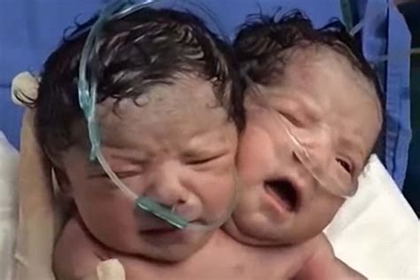Conjoined Twins Born With One Body