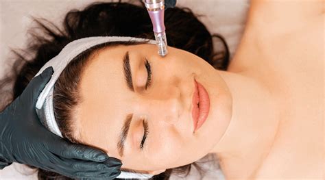 microneedling before and after one treatment what to expect dermatology sa