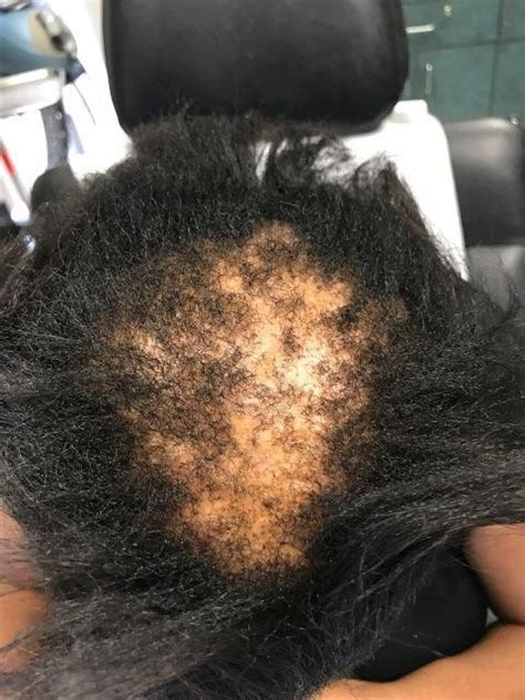 This a place to share your experiences — for better or worse. Witty alopecia hairstyles black women in 2020 | Hair loss ...