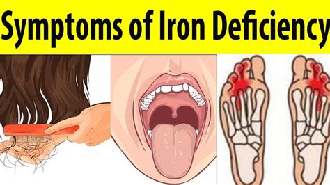 Signs You Have An Iron Deficiency Sports Health Wellbeing