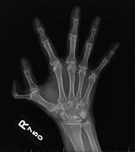 A 3 View X Ray Of The Right Hand Showed Preaxial Polydactyly A