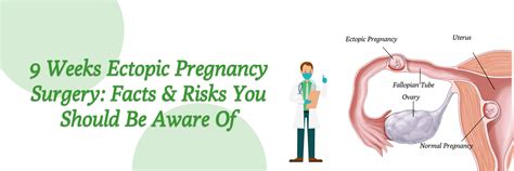 Week Ectopic Pregnancy Surgery Risks And Facts To Know