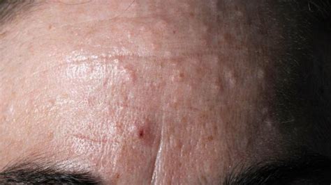Read all information of sebaceous hyperplasia symptoms, treatments, causes, tests & preventions. Sebaceous Hyperplasia - Treatment, Photos, Removal, Causes