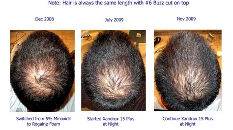 minoxidil side effects rogaine effect choices