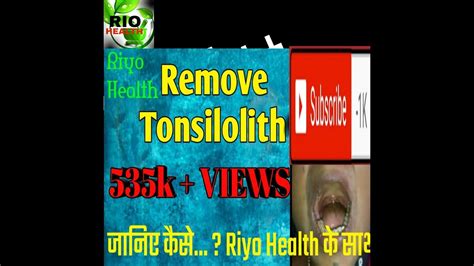 Tonsil Stonestonsillolith Removal Drs Hakir Youtube