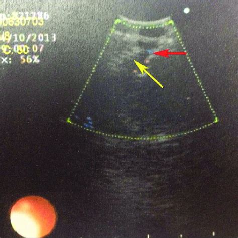 Convex Probe Endobronchial Ultrasound Image Showing An Enlarged Right