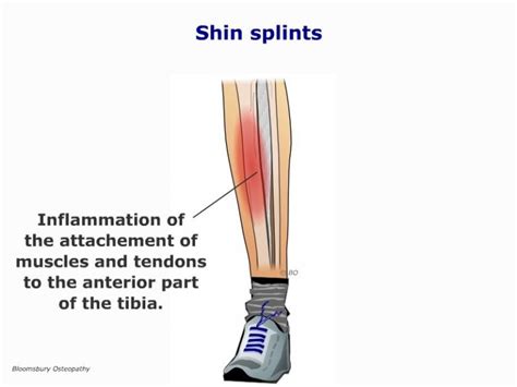 Bloomsbury Health Centre Shin Splints Legp08