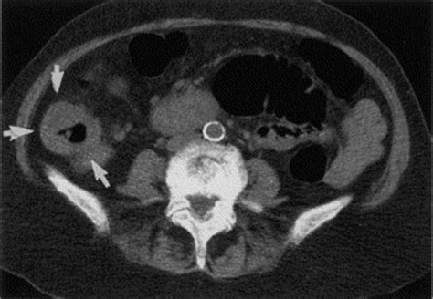 The computed tomography (ct) is used in the clinical practice for detection of tumor, node, and metastasis (tnm) staging of colon t3 stage. CT colonography (virtual colonoscopy) for the detection of ...