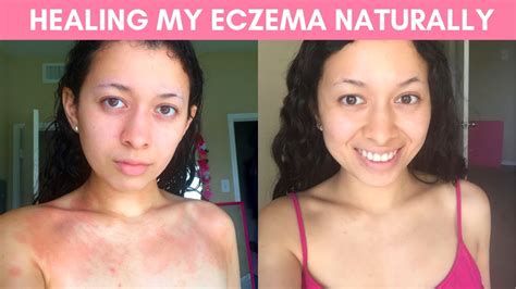 How I Cured My Eczema Naturally How I Prevent Eczema Flareups Forever