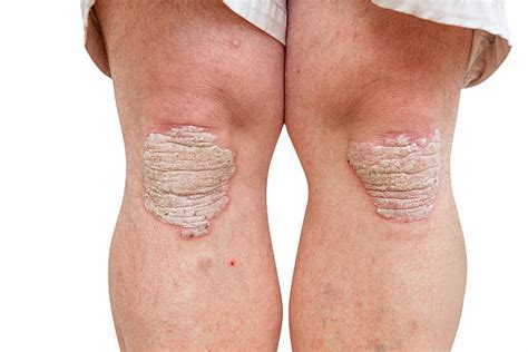 Photo Of Psoriasis Stock Photos Pictures And Royalty Free Images Istock