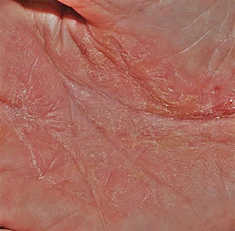 Tinea Fungal Infection
