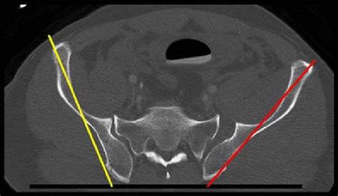 Axial Computed Tomography Ct Of The Pelvis Can Be Used To Estimate