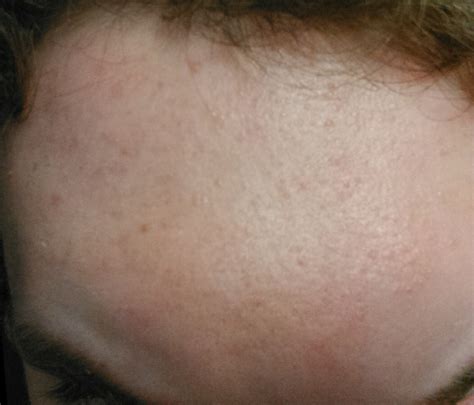 Small Colorless Bumps All Over Forehead General Acne Discussion By