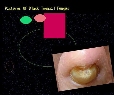 Black Fungus Under Toenail Is My Black Toenail Caused By Fungus