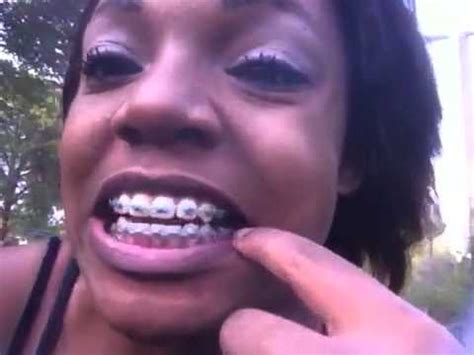 First what your orthodontist does is finds a band that fits. Putting elastics on your braces - YouTube
