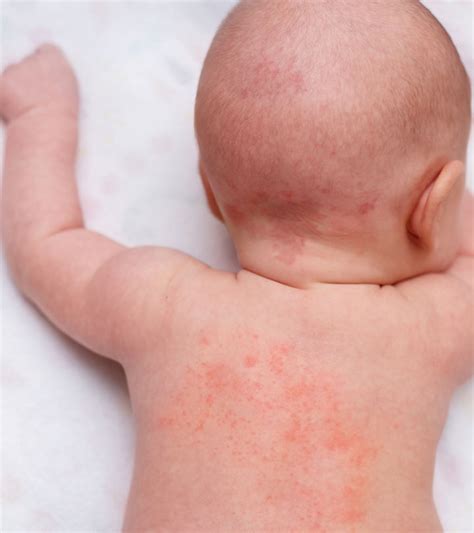 Baby Heat Rash Types Symptoms Treatment And Prevention