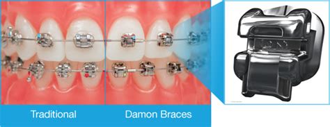 Damon Braces Brush And Floss Dental Center Stratford Ct