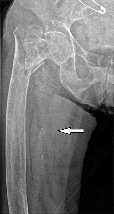 Femoral Pulse Tyreddish