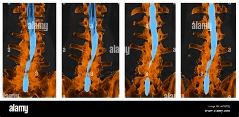 Ct Scan With Myelogram Showing Spinal Stenosis Of The Lumbar Spine