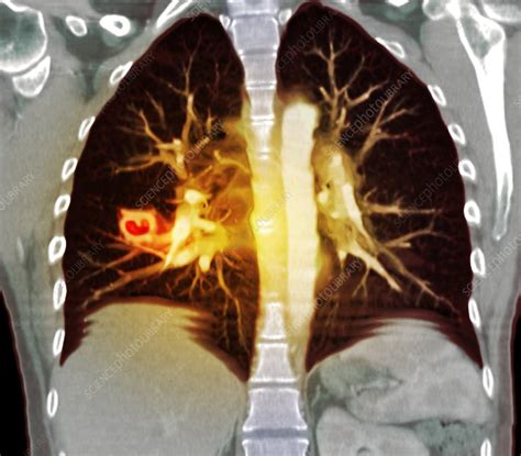Lung Lesions Ct Scan Stock Image M2400783 Science Photo Library