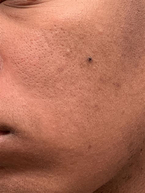 Acne Is These Blackheads Or Something Else And How Should I Go About