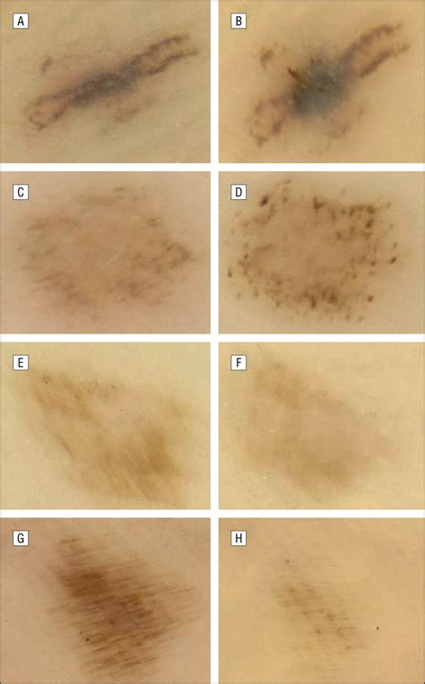 Dermoscopic Changes In Acral Melanocytic Nevi During Digital Follow Up