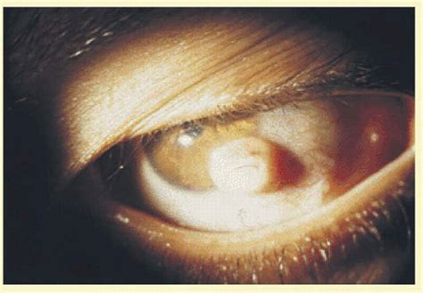 Teratology Of The Eye Ento Key