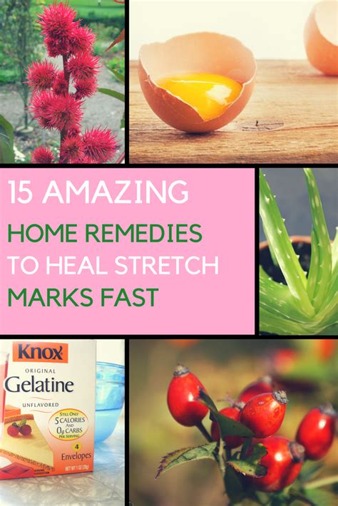 10 Amazing Home Remedies For Stretch Marks