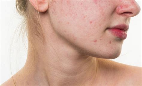 Highly Suggested Acne Vulgaris Treatments Health Info Med