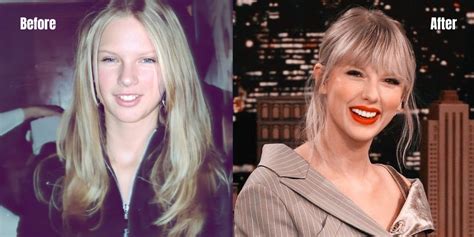 Taylor Swift Before And After Teeth