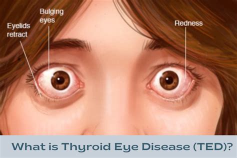 What Is Thyroid Eye Disease Ted Ophthalmologist Dubai